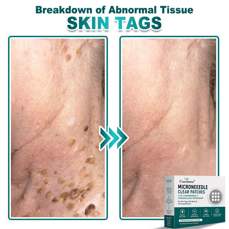 🔥 Curalona® 2-in-1 Microneedle & Hydrocolloid Patch | For Skin Tags, Flat Warts & Raised Skin Imperfections | Visible Improvement in As Little As 5 Days | Invisible Face & Body Patches