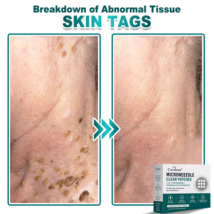 🔥 Curalona® 2-in-1 Microneedle & Hydrocolloid Patch | For Skin Tags, Flat Warts & Raised Skin Imperfections | Visible Improvement in As Little As 5 Days | Invisible Face & Body Patches