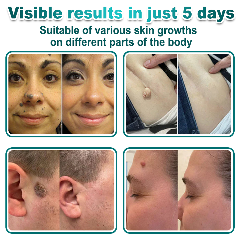 🔥 Curalona® 2-in-1 Microneedle & Hydrocolloid Patch | For Skin Tags, Flat Warts & Raised Skin Imperfections | Visible Improvement in As Little As 5 Days | Invisible Face & Body Patches