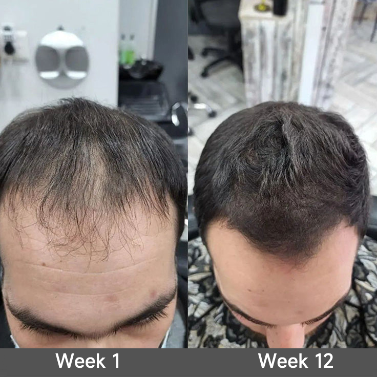 🇺🇸 Official U.S. Store | PURELORA® 2-in-1 Onion & Rosemary Shampoo + Conditioner 🌿 | 15X Active Complex for Fuller, Thicker-Looking & Stronger Hair