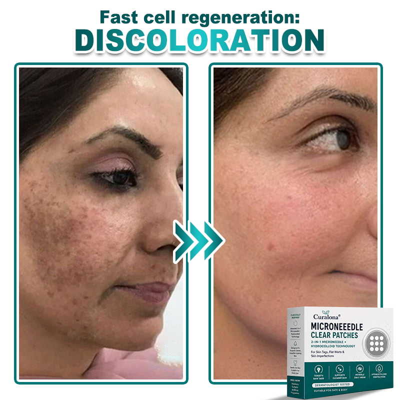 🔥 Curalona® 2-in-1 Microneedle & Hydrocolloid Patch | For Skin Tags, Flat Warts & Raised Skin Imperfections | Visible Improvement in As Little As 5 Days | Invisible Face & Body Patches