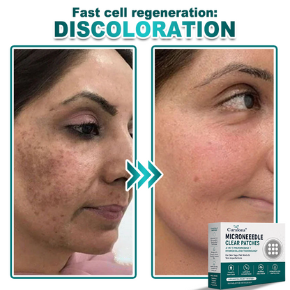 🔥 Curalona® 2-in-1 Microneedle & Hydrocolloid Patch | For Skin Tags, Flat Warts & Raised Skin Imperfections | Visible Improvement in As Little As 5 Days | Invisible Face & Body Patches