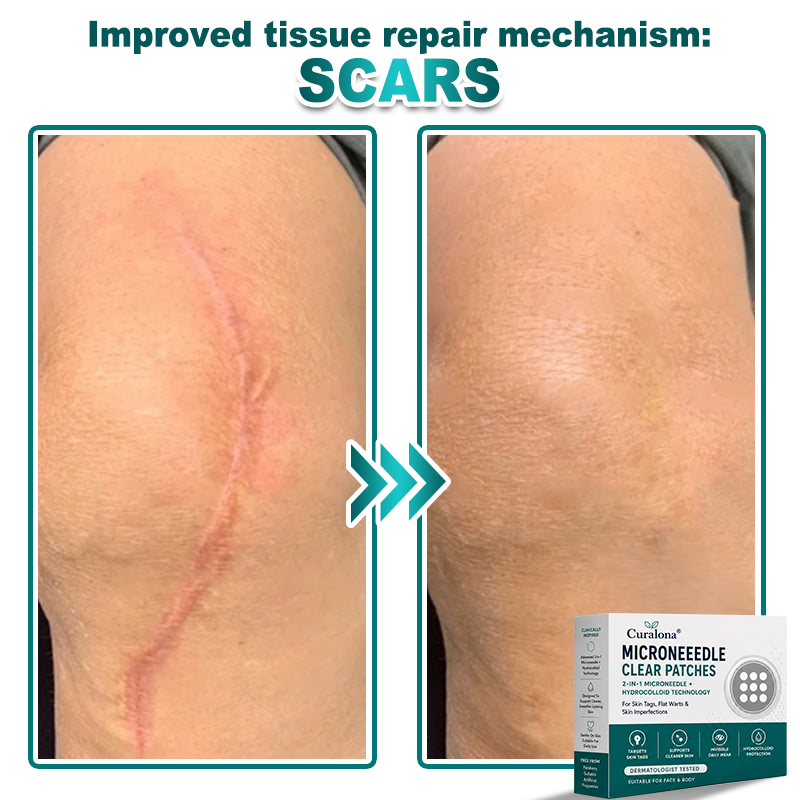 🔥 Curalona® 2-in-1 Microneedle & Hydrocolloid Patch | For Skin Tags, Flat Warts & Raised Skin Imperfections | Visible Improvement in As Little As 5 Days | Invisible Face & Body Patches