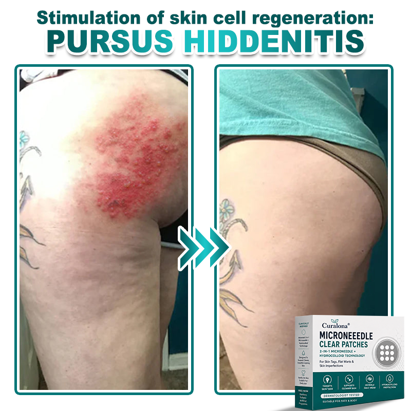 🔥 Curalona® 2-in-1 Microneedle & Hydrocolloid Patch | For Skin Tags, Flat Warts & Raised Skin Imperfections | Visible Improvement in As Little As 5 Days | Invisible Face & Body Patches