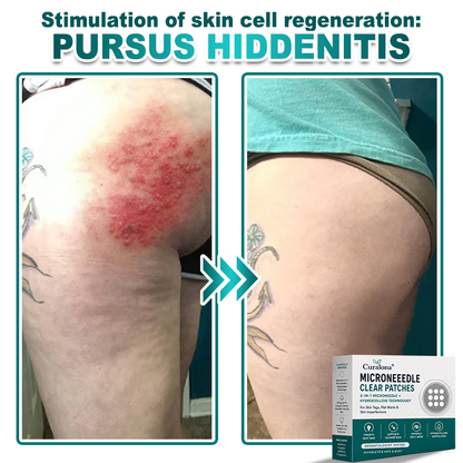 🔥 Curalona® 2-in-1 Microneedle & Hydrocolloid Patch | For Skin Tags, Flat Warts & Raised Skin Imperfections | Visible Improvement in As Little As 5 Days | Invisible Face & Body Patches
