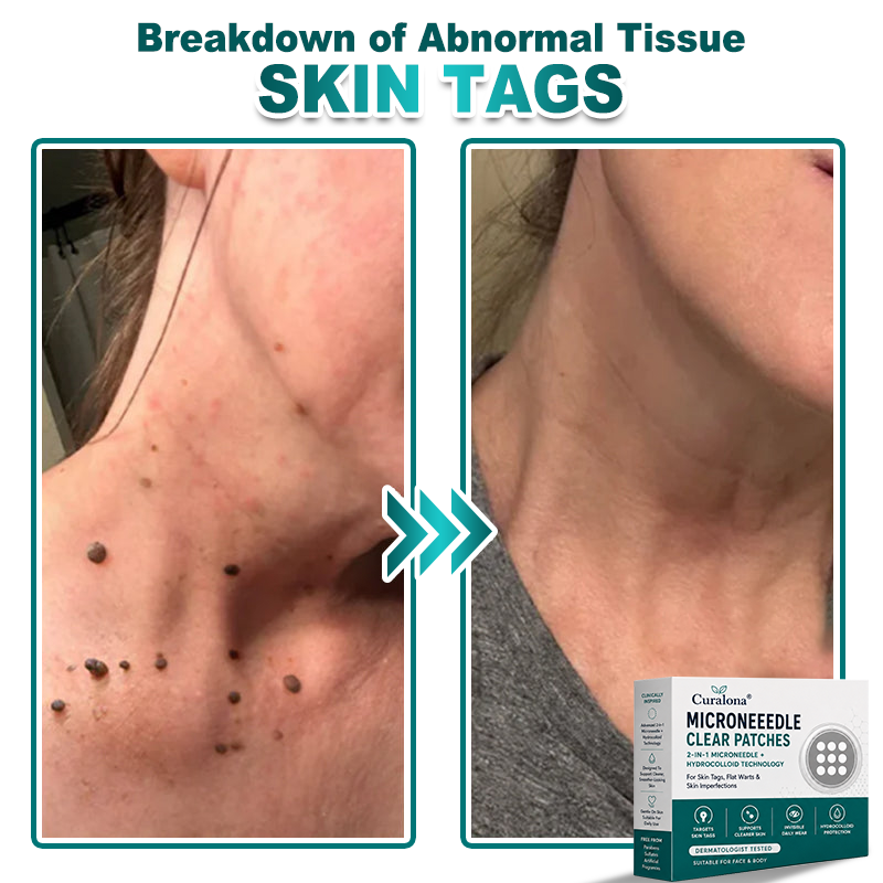 🔥 Curalona® 2-in-1 Microneedle & Hydrocolloid Patch | For Skin Tags, Flat Warts & Raised Skin Imperfections | Visible Improvement in As Little As 5 Days | Invisible Face & Body Patches