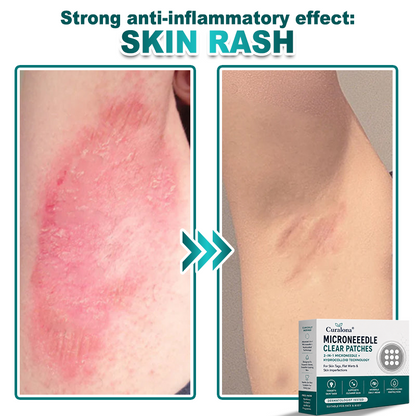 🔥 Curalona® 2-in-1 Microneedle & Hydrocolloid Patch | For Skin Tags, Flat Warts & Raised Skin Imperfections | Visible Improvement in As Little As 5 Days | Invisible Face & Body Patches