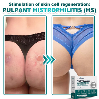 🔥 Curalona® 2-in-1 Microneedle & Hydrocolloid Patch | For Skin Tags, Flat Warts & Raised Skin Imperfections | Visible Improvement in As Little As 5 Days | Invisible Face & Body Patches